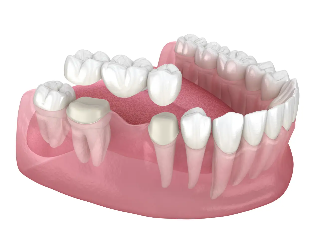 Dental bridge showing how to replace lost teeth-Dentus perfectus dental work Dental bridge showing how to replace lost teeth-Dentus perfectus dental work