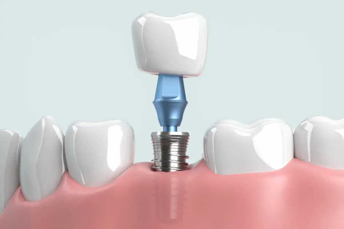 Dental implant in 3 parts Dental implant in 3 parts: dental implant (titanium screw) superstructure and dental crown