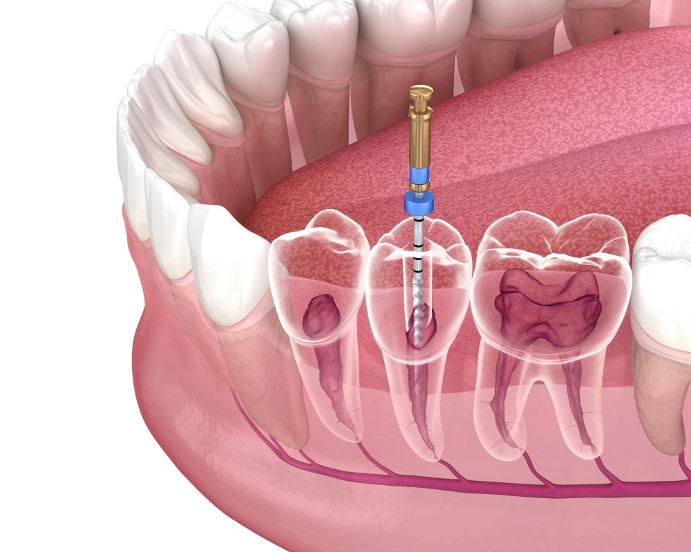Root canal treatment in Dentus perfectus dental office Root canal treatment in Dentus perfectus dental office