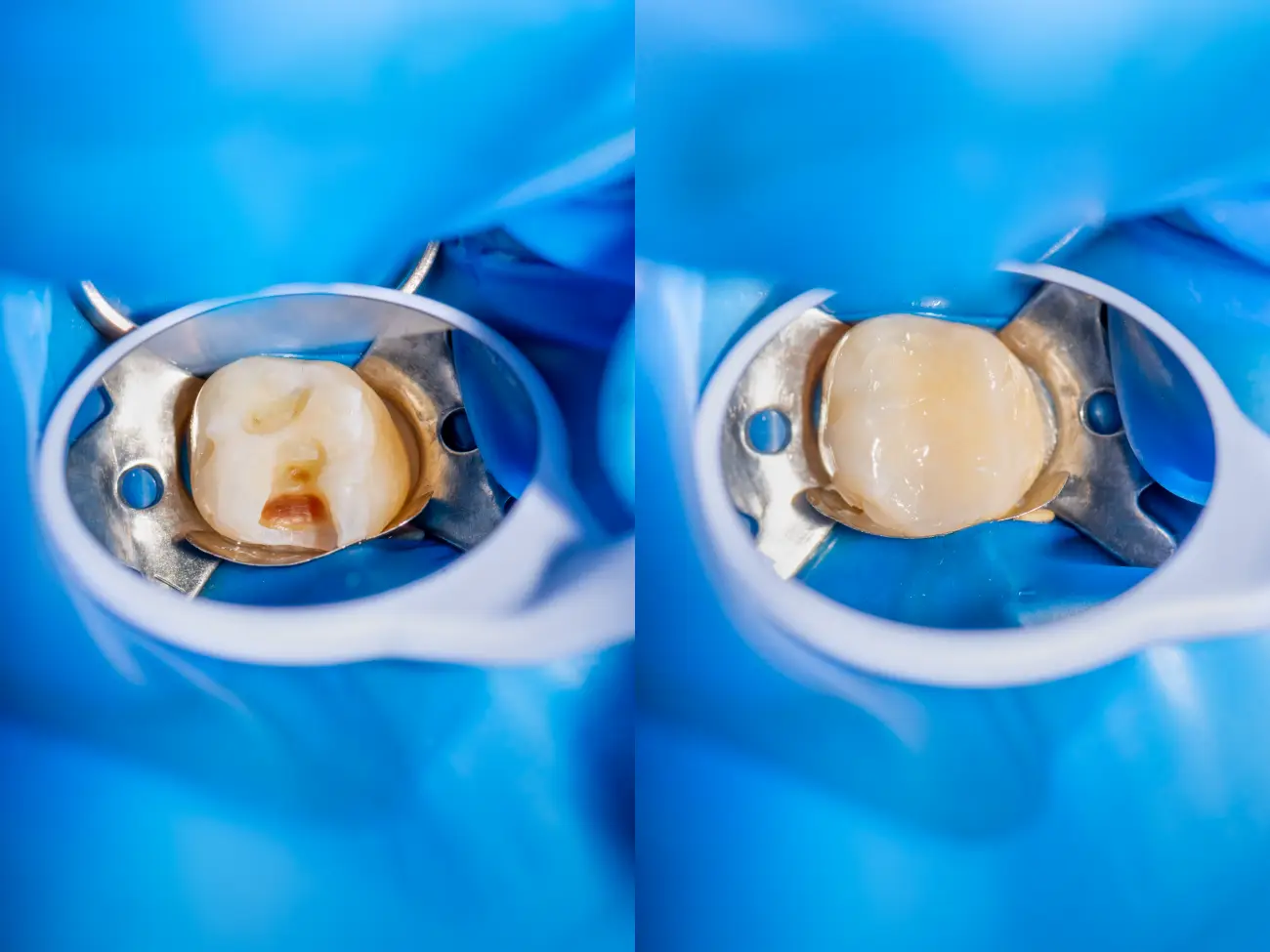 Tooth Repair in Dentus perfectus dental office Tooth Repair in Dentus perfectus dental office - picture shows tooth before and after the procedure in Dentus perfectus dental office