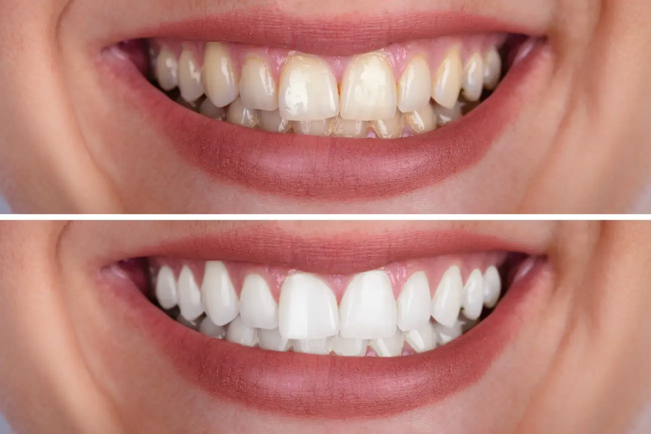 aesthetic dentistry- teeth whitening - Zagreb - teeth before and after the treatment aesthetic dentistry- teeth whitening - Zagreb - teeth before and after the treatment in Dentus perfectus dental office