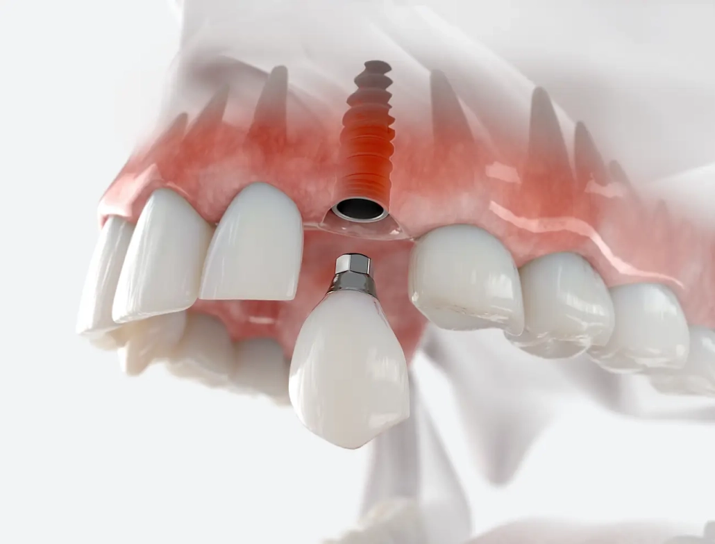 dental implant Zagreb