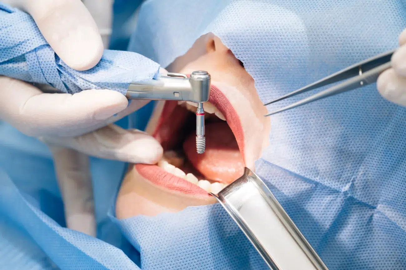 dental implants in Dentus perfectus dental office in Zagreb dental implants in Dentus perfectus dental office in Zagreb