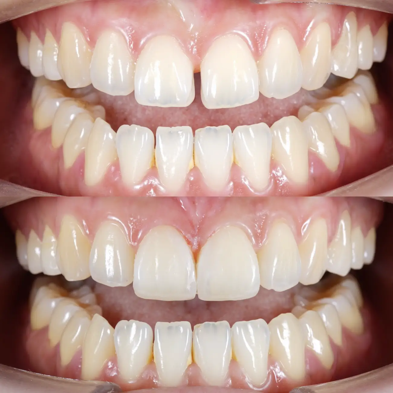 dental veneers in Dentus perfectus dental clinic - picture is showing teeth before and after the treatment
