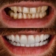 Paradentoza i navlake za zube – kako paradentoza utječe na zube i zubnu protetiku - parodontološka terapija u ordinaciji Dentus Perfectus Zagreb.