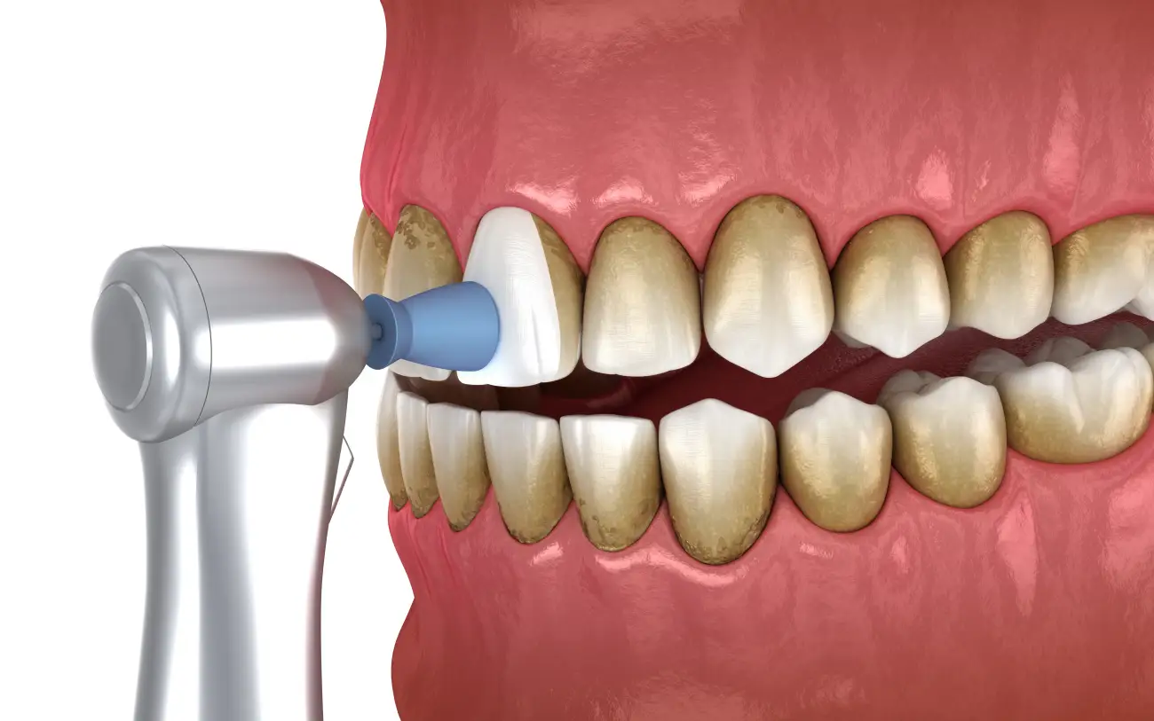 picture is showing the proces of teeth polishing picture is showing the proces of teeth polishing