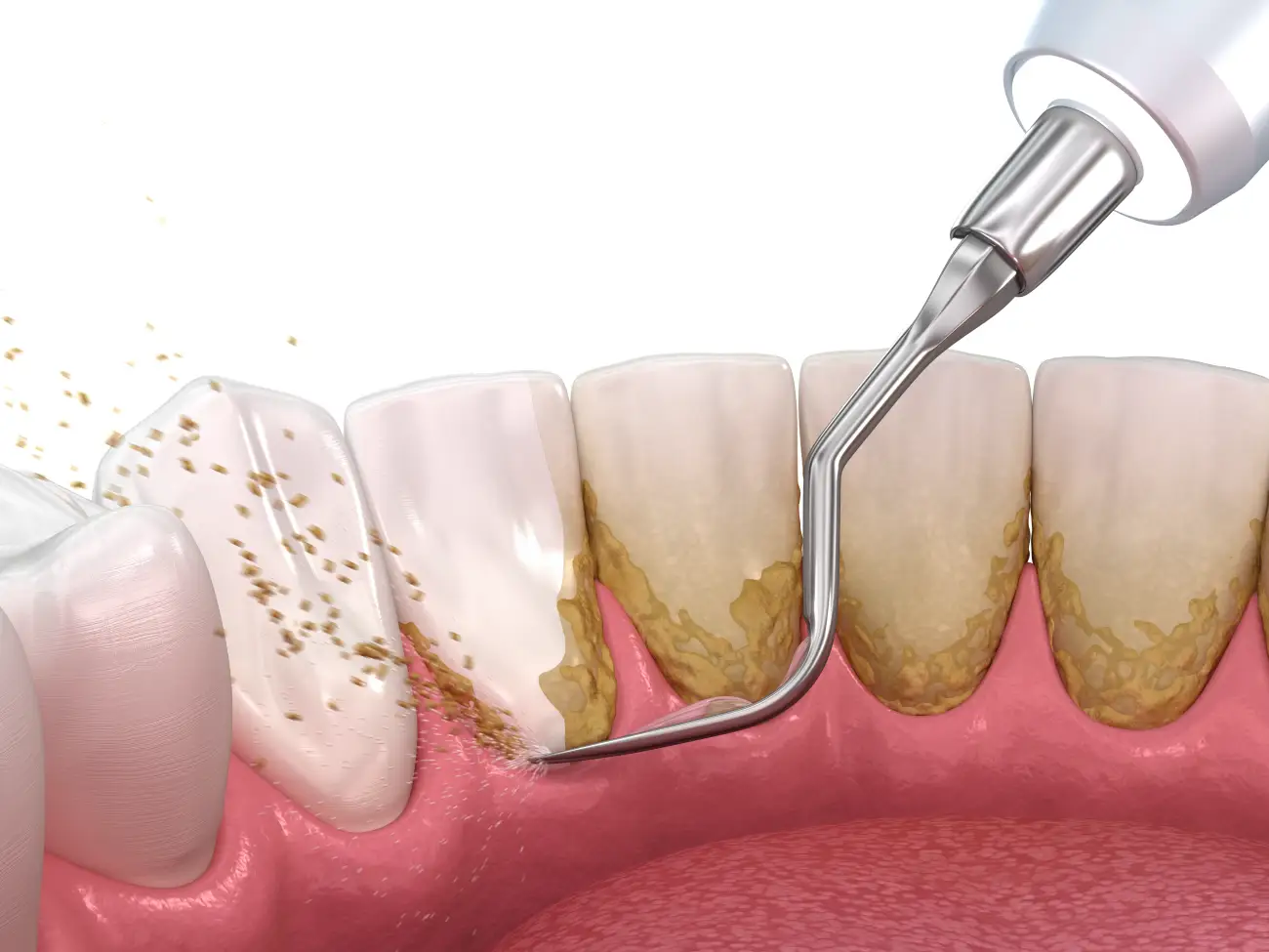 professional hygiene - Dentus perfectus