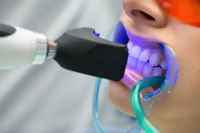 teeth whitening procedure during treatment of a patient teeth whitening procedure during treatment of a patient