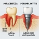 Lijevo je prikaz paradentoze s upaljenim desnima i gubitkom kosti, a desno periimplantitis s kroničnom upalom oko implantata i gubitkom okolne kosti.