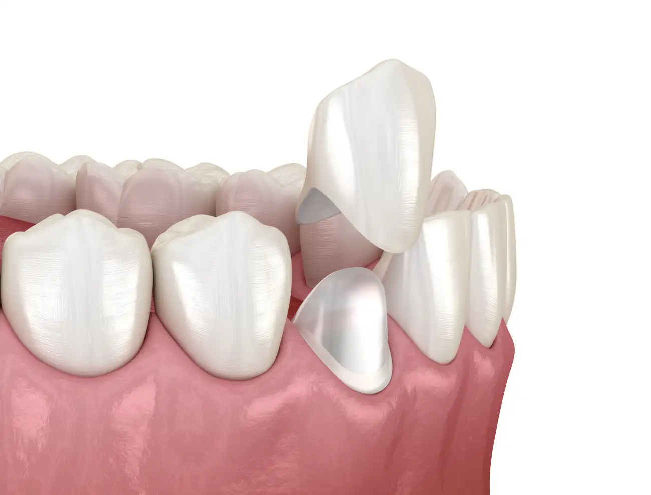 dental crowns procedure in Dentus perfectus dental practice dental crowns procedure in Dentus perfectus dental practice