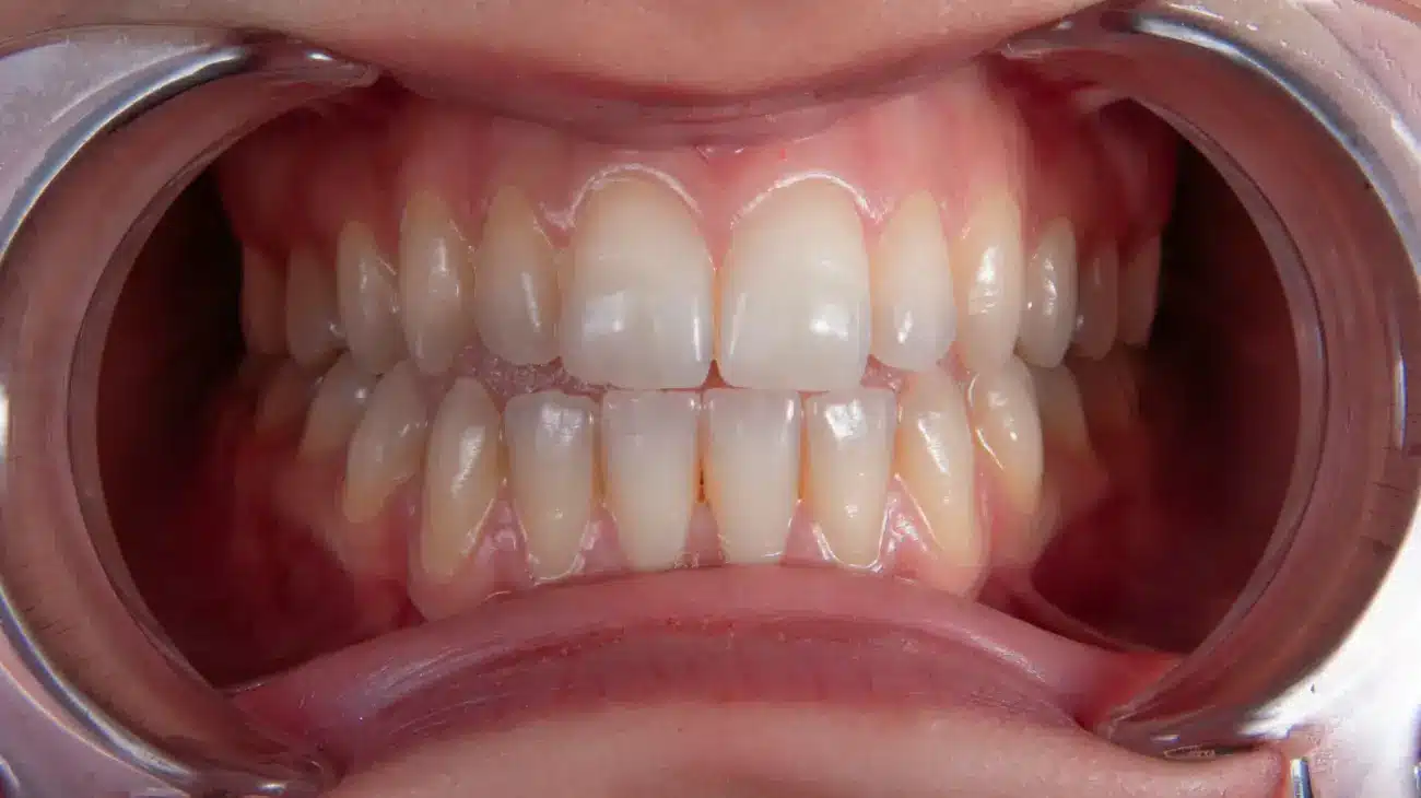 healthy gums after the treatment in Dentus perfectus dental practice
