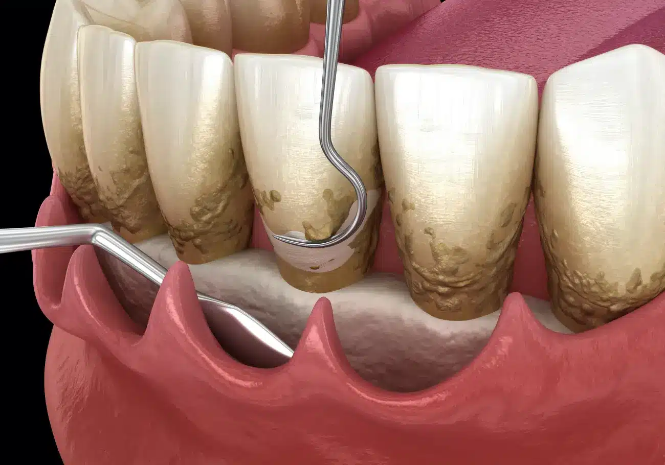 scaling and root planing - dental curretage in Dentus perfectus dental office
