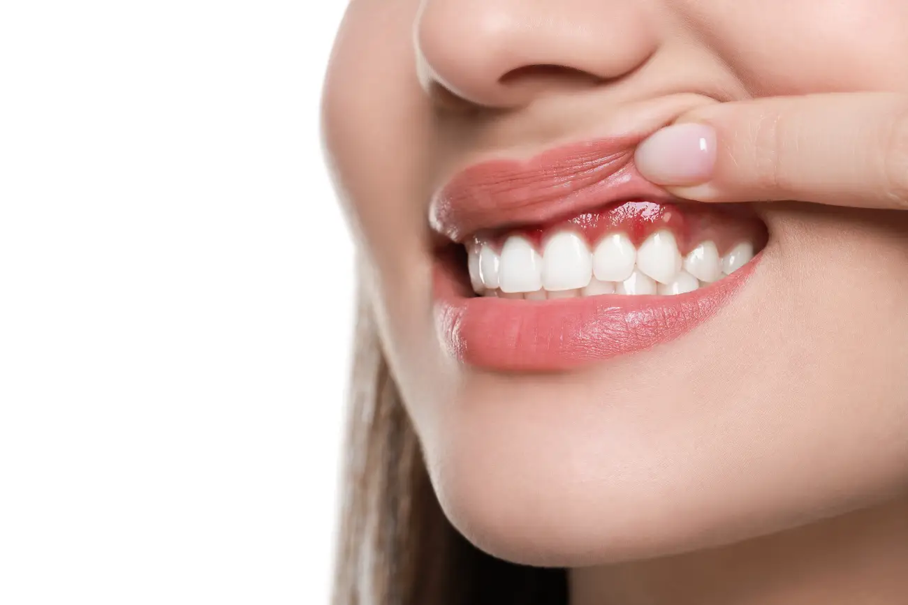 signs of the periodontitis