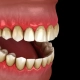 the illustration of the bleeding gums