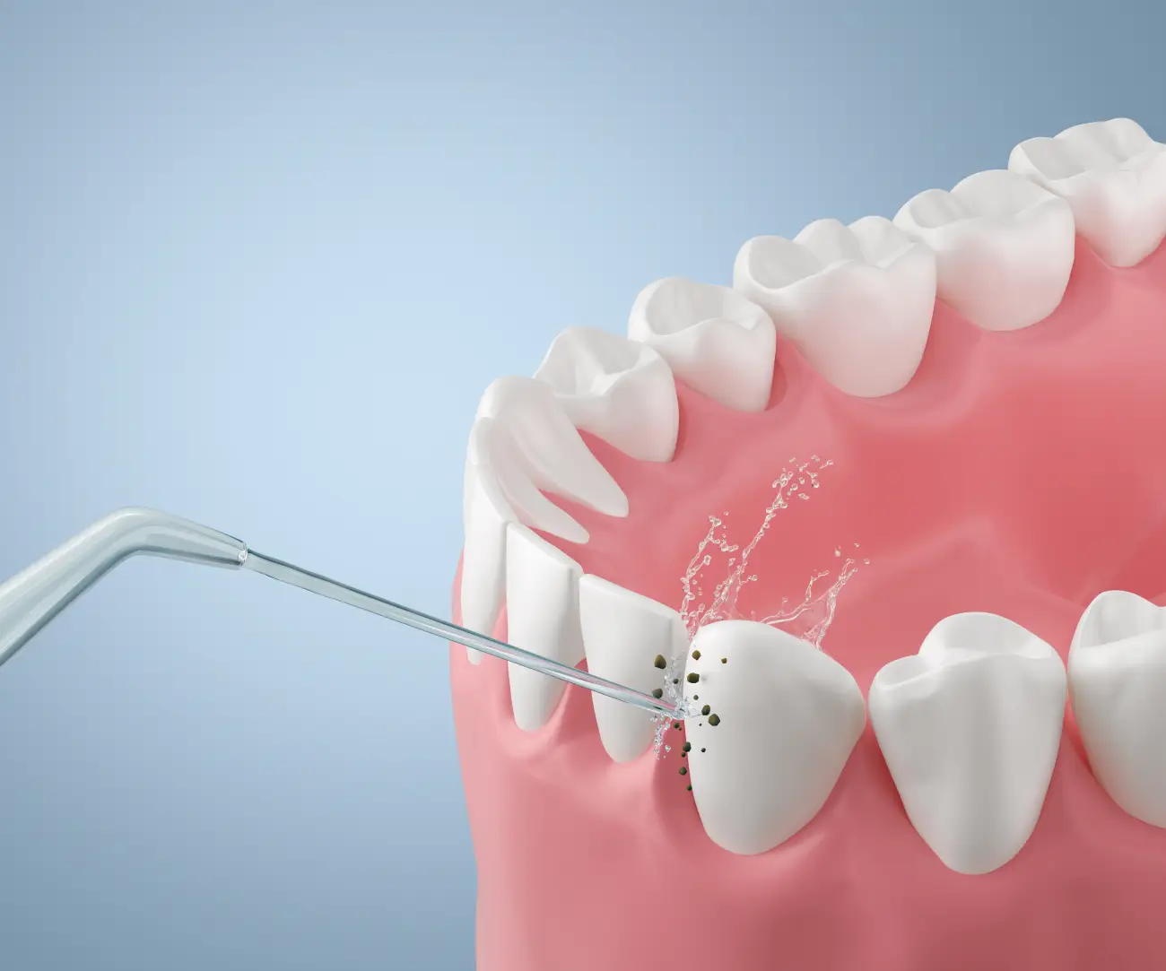 zapinje mi hrana među zubima - Dentus perfectus ordinacija Zapinje mi hrana među zubima - Detaljna 2D ilustracija dvaju zuba s komadićem hrane zaglavljenim u interdentalnom prostoru.