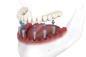 All on 6 - Dentus perfectus - implantologija i zubni implantati slika prikazuje kako izgleda all on 6 terapija na 6 implantata
