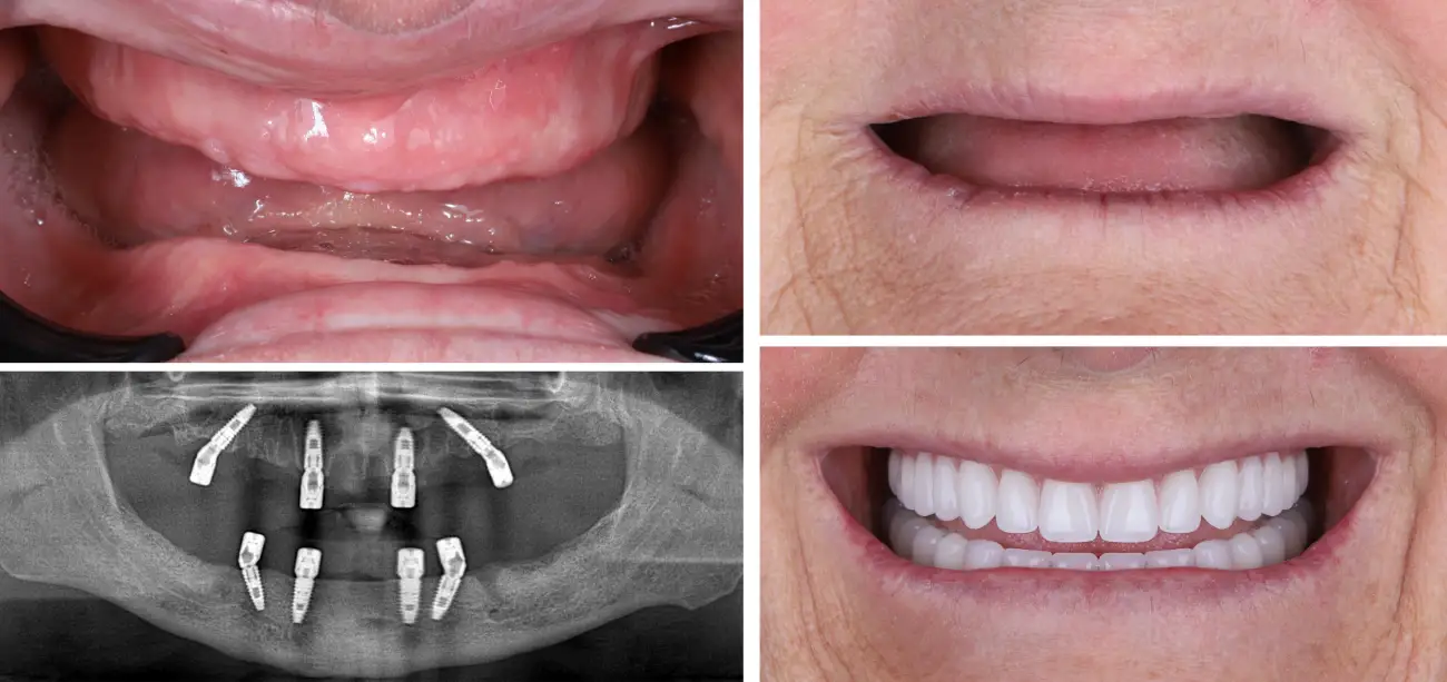 all-on-4-dentus-perfectus All on 4 terapija prikazuje korake do potpunog seta zubi.
