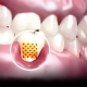 Dentinska preosjetljivost zubi: Slika prikazuje zub s povučenim zubnim mesom: vidi se izloženi žućkasti dentin s vidljivim otvorenim kanalićima na mjestu gdje je došlo do recesije desni. Dentus perfectus stomatološka ordinacija
