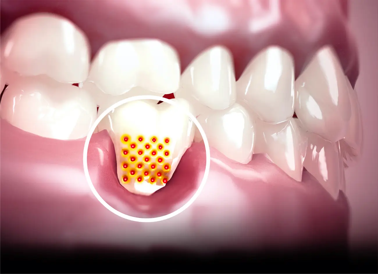dentinska preosjetljivost zubi - Dentus perfectus stomatolosĢka ordinacija Dentinska preosjetljivost zubi: Slika prikazuje zub s povuÄenim zubnim mesom: vidi se izloženi žuÄkasti dentin s vidljivim otvorenim kanaliÄima na mjestu gdje je doÅ”lo do recesije desni. Dentus perfectus stomatolosĢka ordinacija
