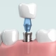 Slika prikazuje zubni implantat u 3 dijela uklopljen u čeljust među zube - Dentus perfectus stomatološka ordinacija
