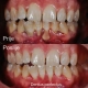 Slika prikazuje gingiva i gingivalnu recesije prije tretmana i poslije tretmana. U samo jednom tretmanu vidljiv je velik napredak u zdravlju zuba i desni - Dentus perfectus stomatološka ordinacija