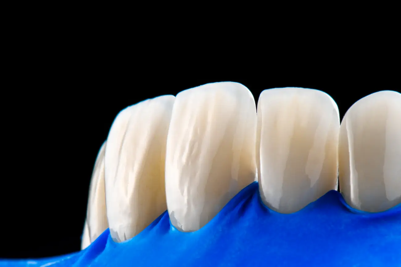 koliko traje izrada zubne krunice? koliko traje izrada zubne krunice? Koliko brzo možete dobiti novi osmijeh uz zubnu krunicu - Dentus perfectus stomatološka ordinacija - Zagreb - Savica