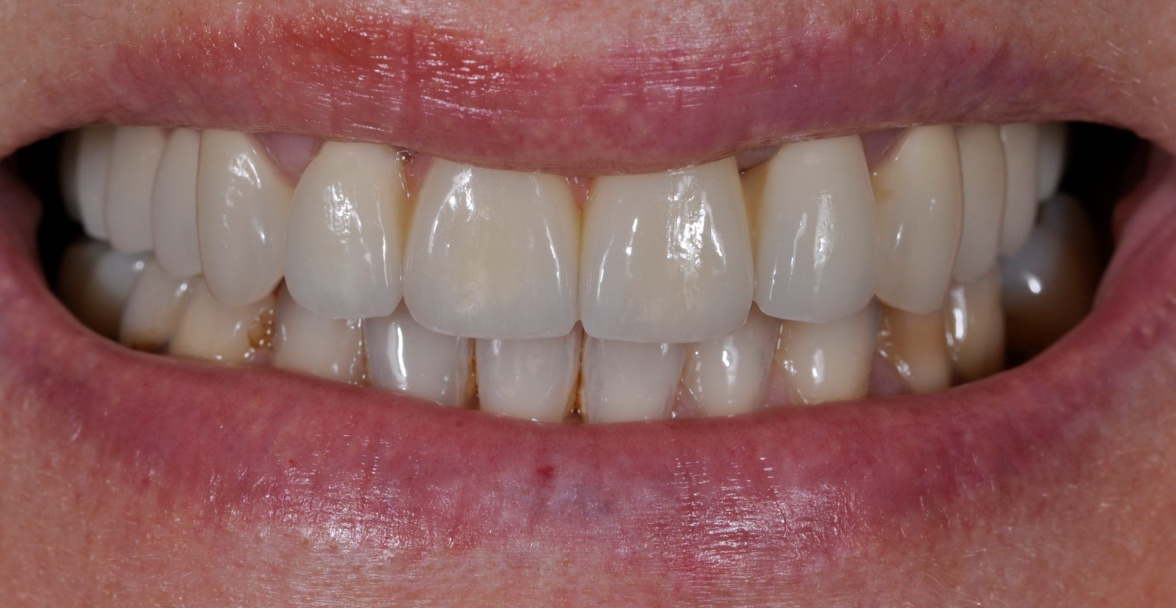 After image