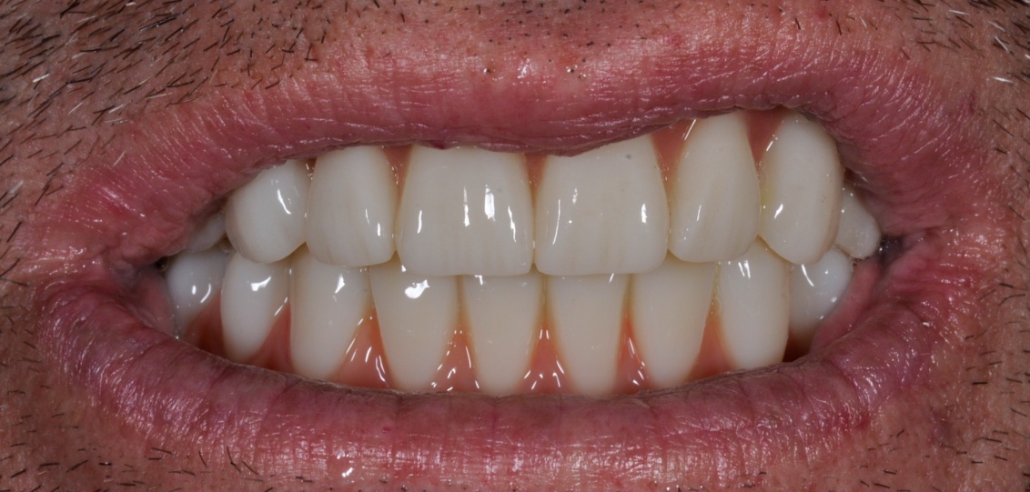 After image