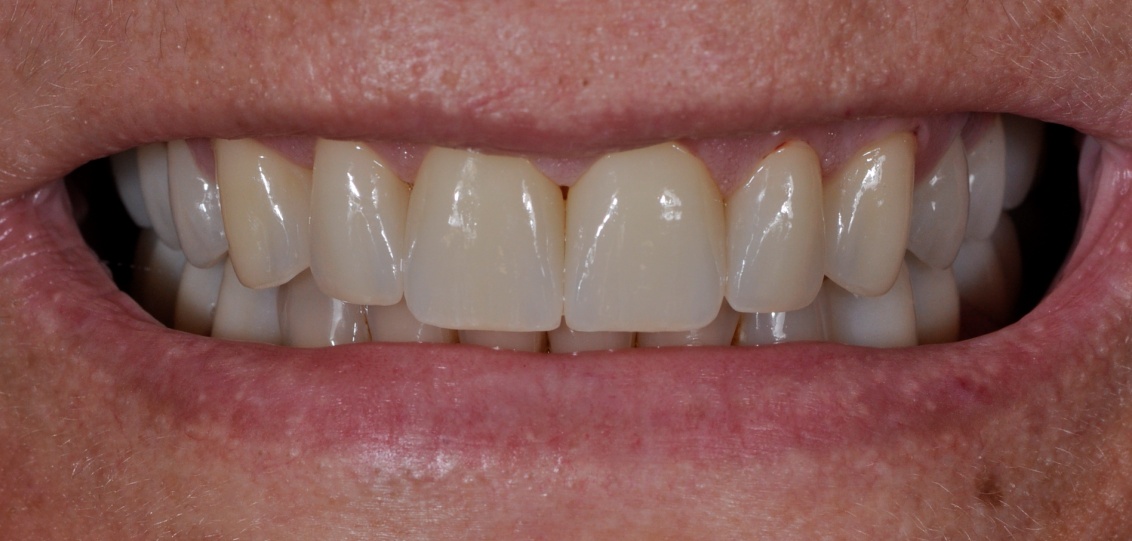 After image