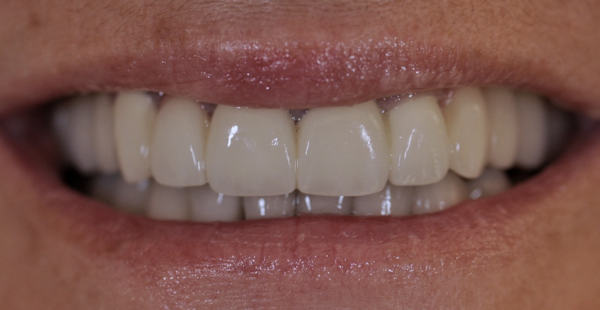 After image