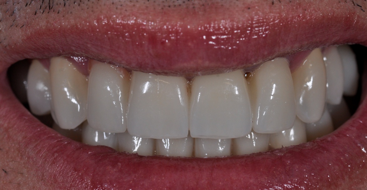 After image