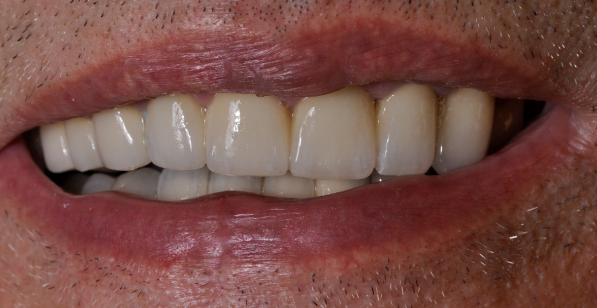 After image
