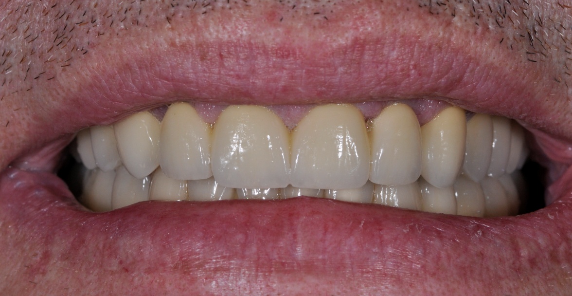 After image