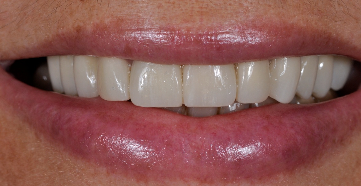 After image