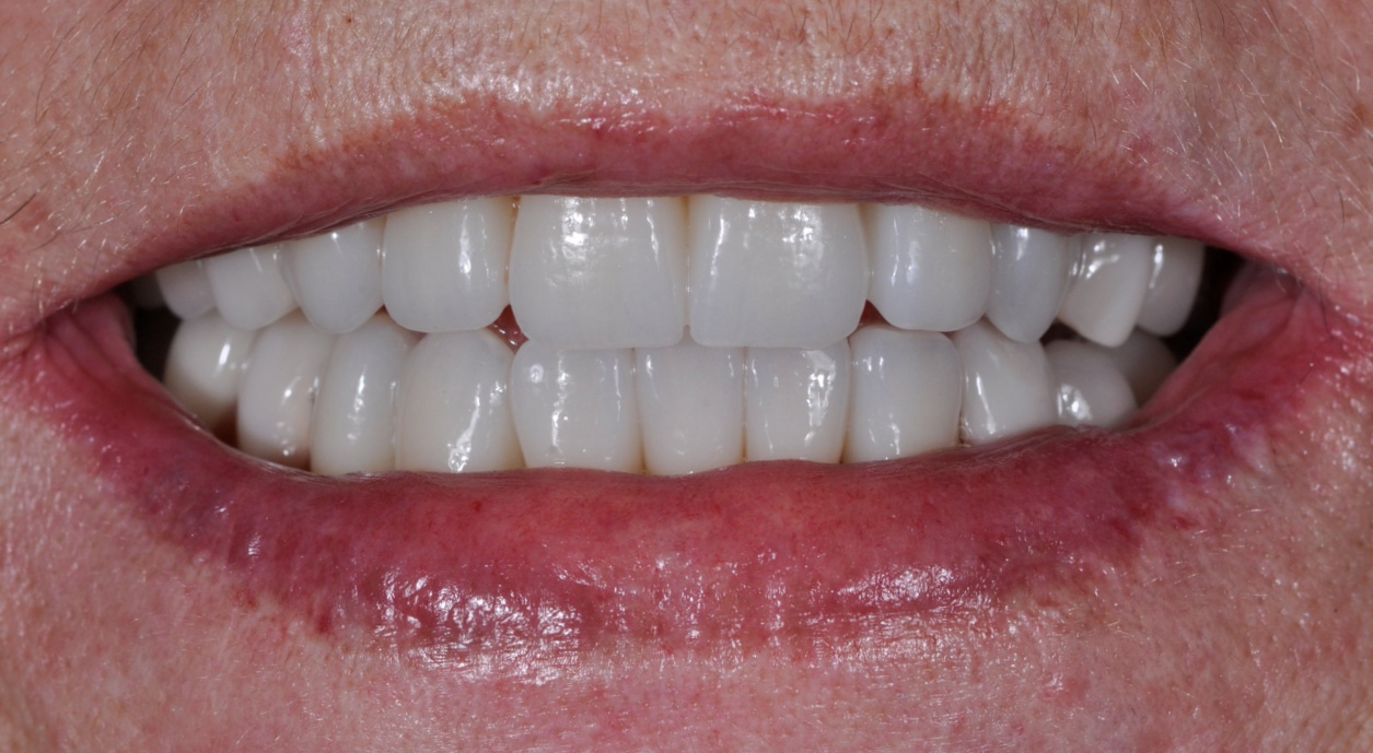 After image