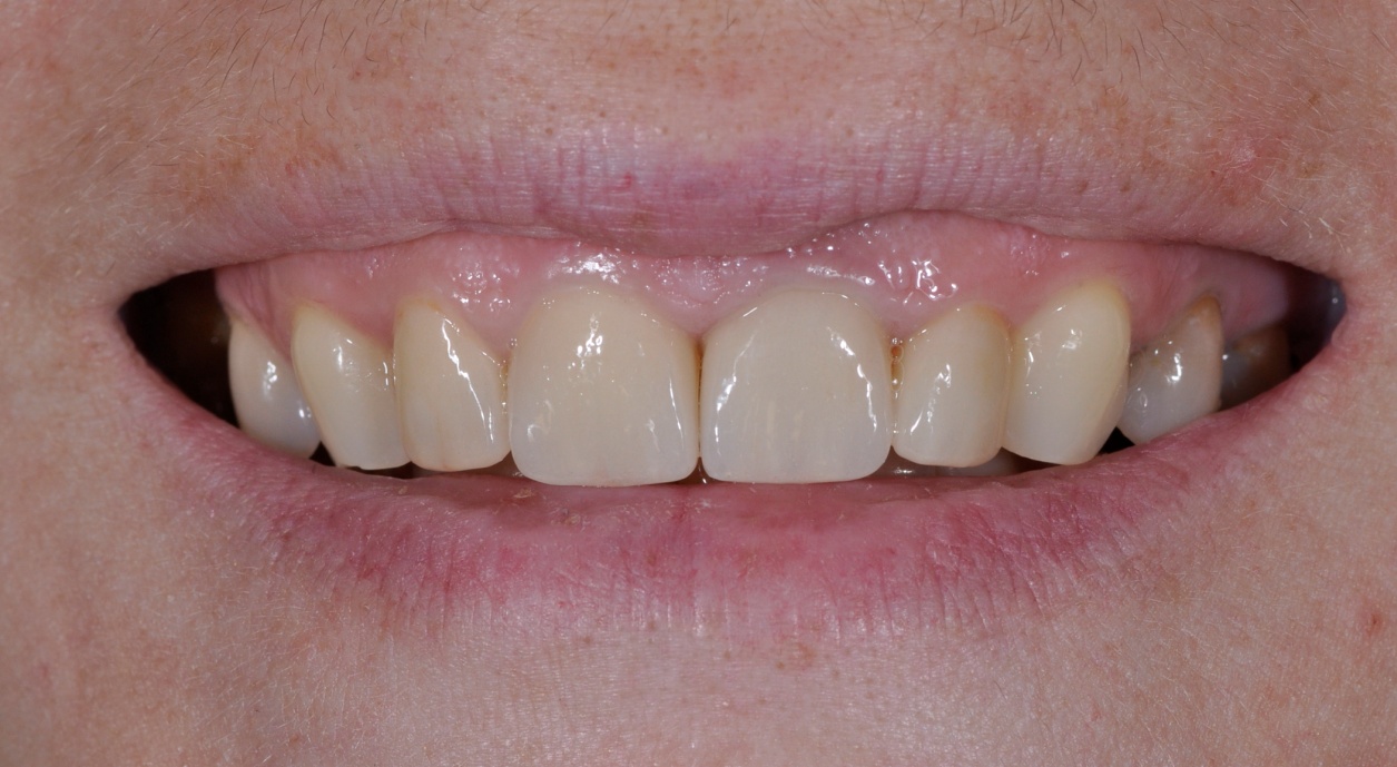 After image