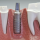 ugradnja implantata i sinus lift zahvat za nadoknadu izgubljenog zuba