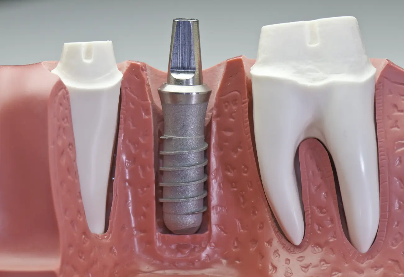 sinus lift i zubni implantat ugradnja implantata i sinus lift zahvat za nadoknadu izgubljenog zuba