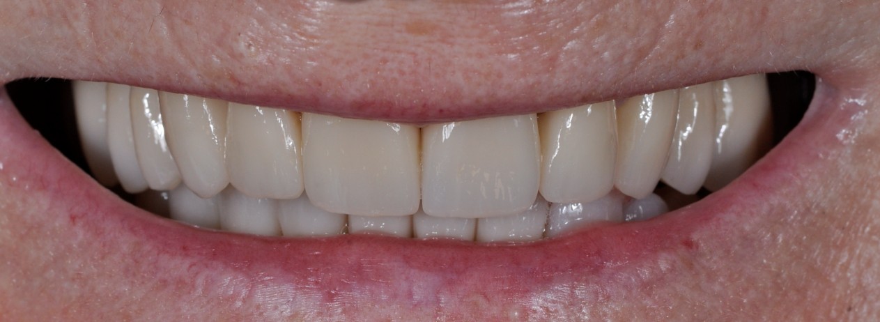 After image